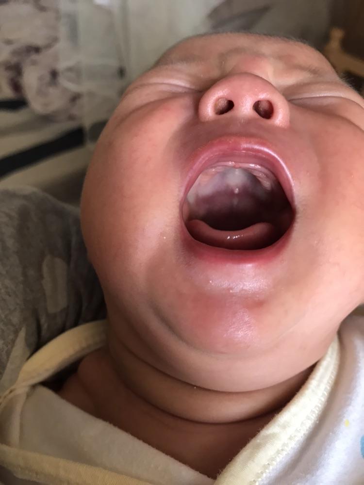 宝宝盘舌头的症状图片图片