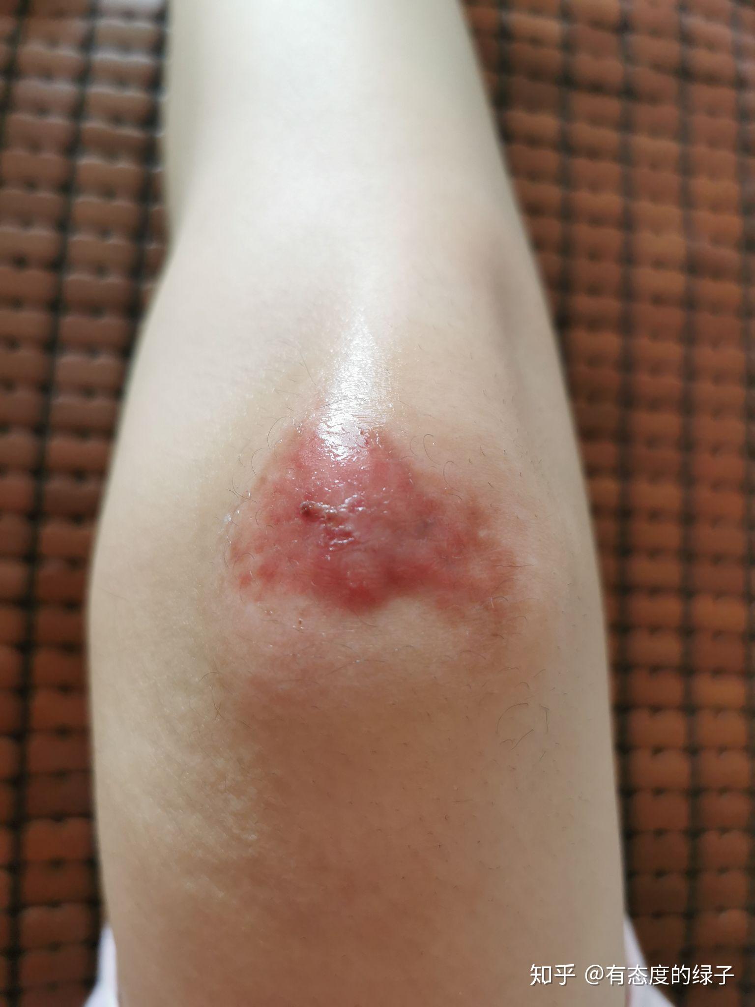 膝盖瘢痕疙瘩 - 知乎