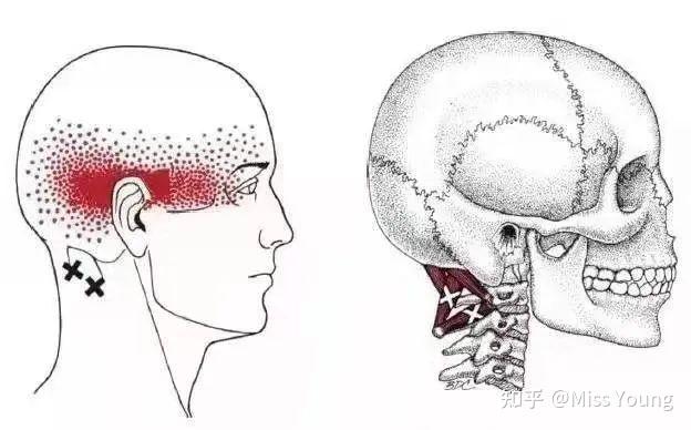 這部分肌肉的疼痛會從後腦勺延伸至眼睛處,給人的感覺就是整個半邊頭