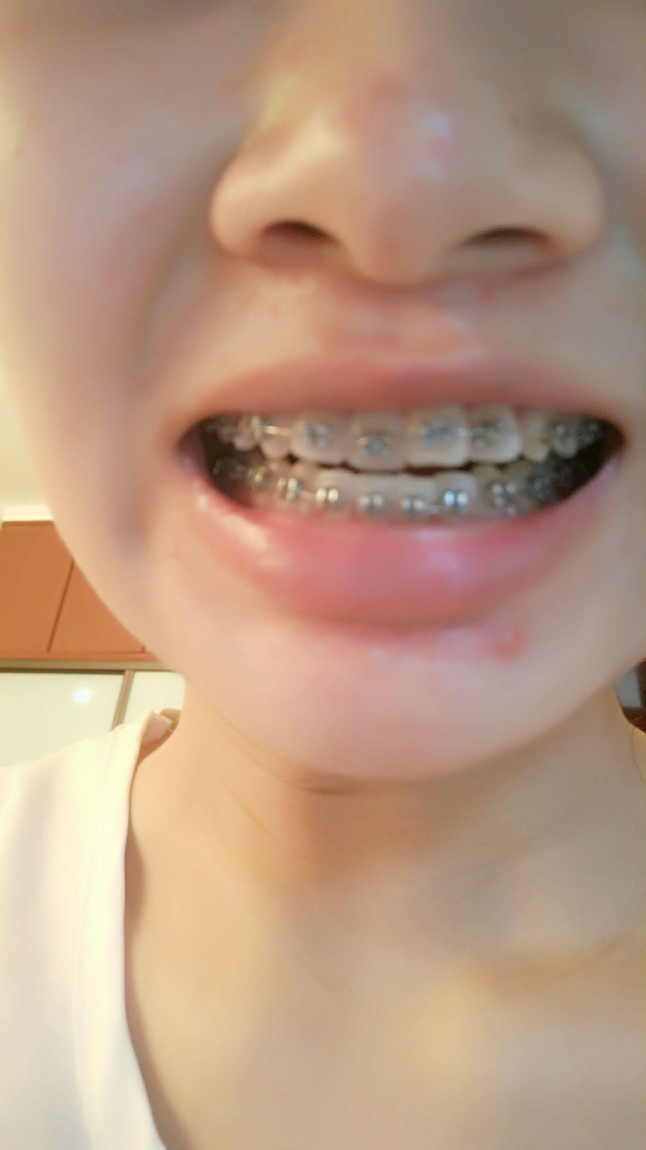 有没有成年地包天矫正经验的童子们?