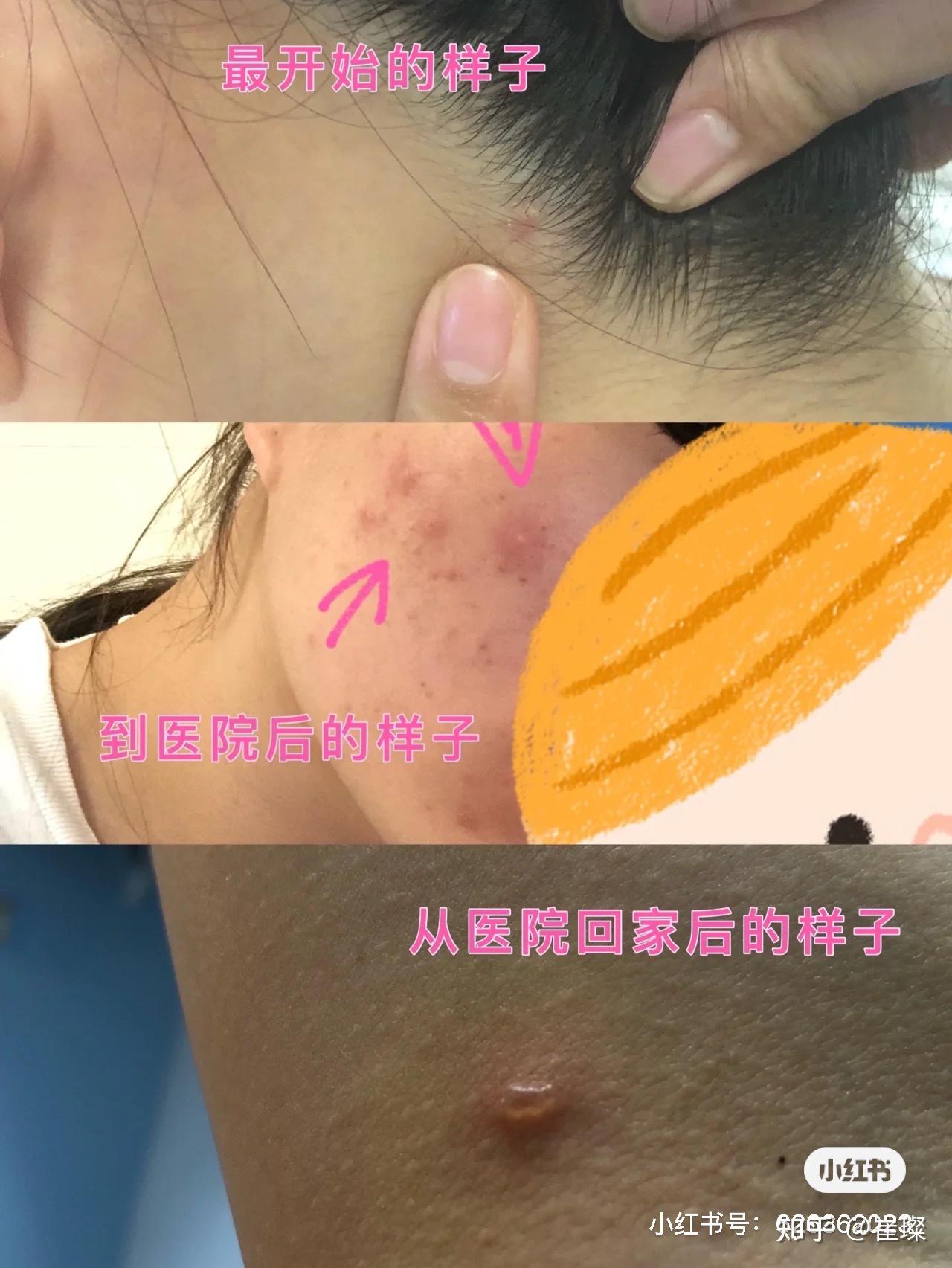 23岁成人水痘,水痘友们借鉴避坑! - 知乎