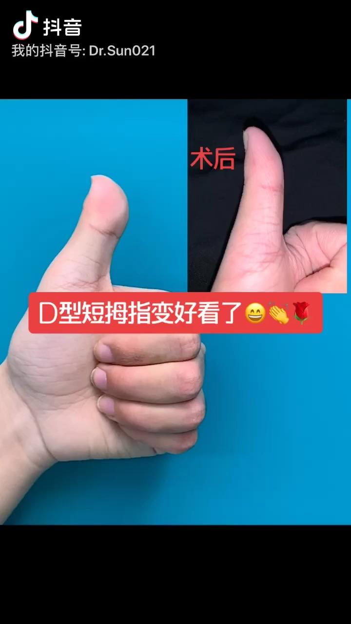 大拇指又宽又短d型短指手术案例
