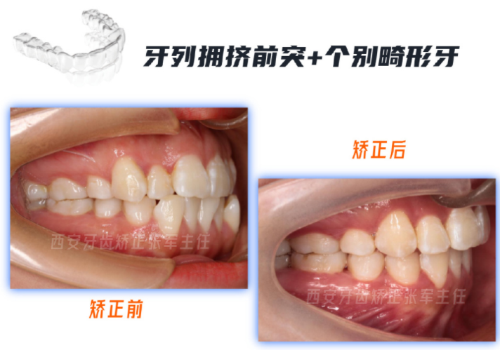 西安隐形矫正拔除1颗正畸牙片切下牙列扩弓上牙列