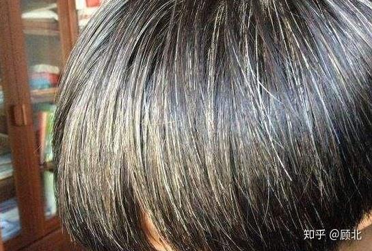 年轻人长白头是什么原因