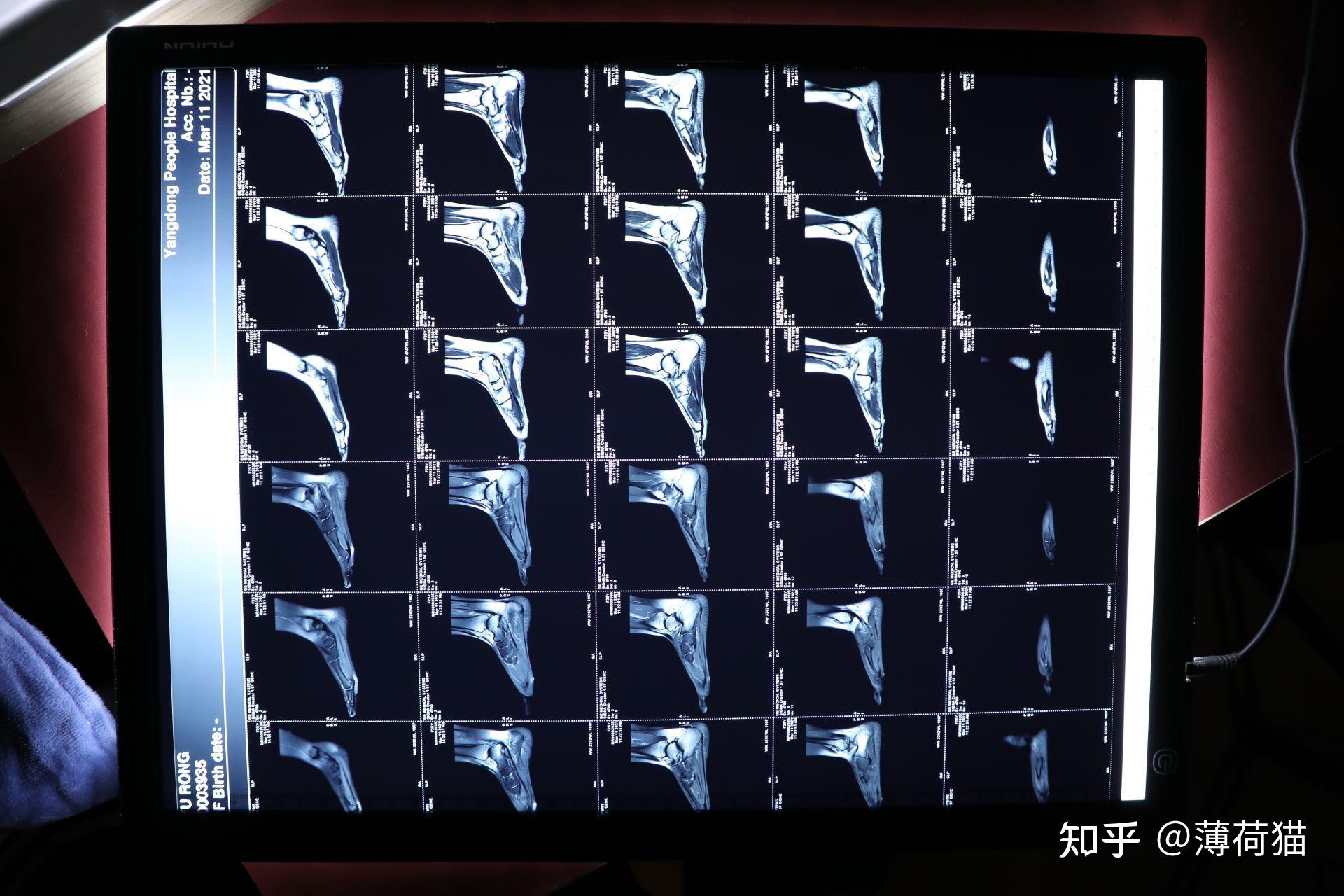 怎样锻炼膝盖和脚踝 v2-76635995dee4bc8a9fe1e488a96fee44_r.jpg