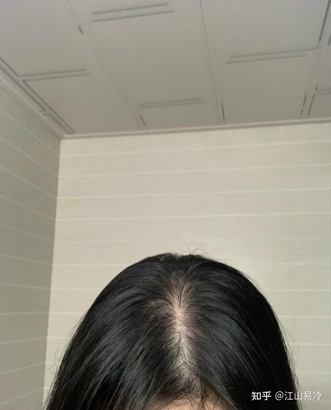 女性脂溢性脱发(女性脂溢性脱发的症状有哪些)