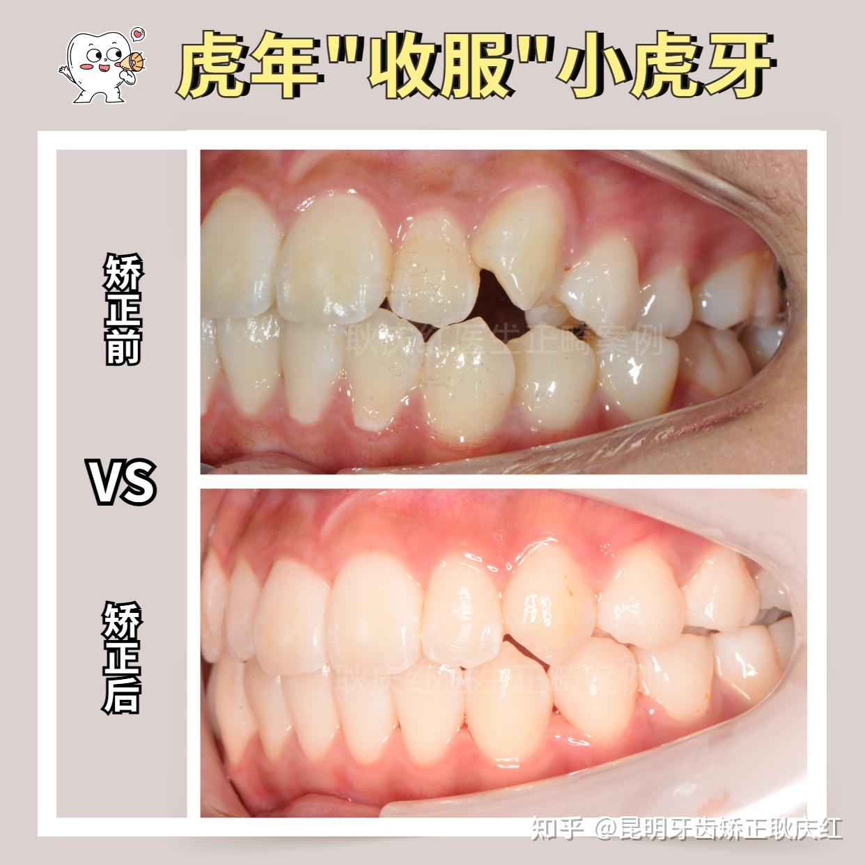 笑起来不好看,下排牙齿不整齐,上排牙齿有两颗虎牙,也不整齐. - 知乎