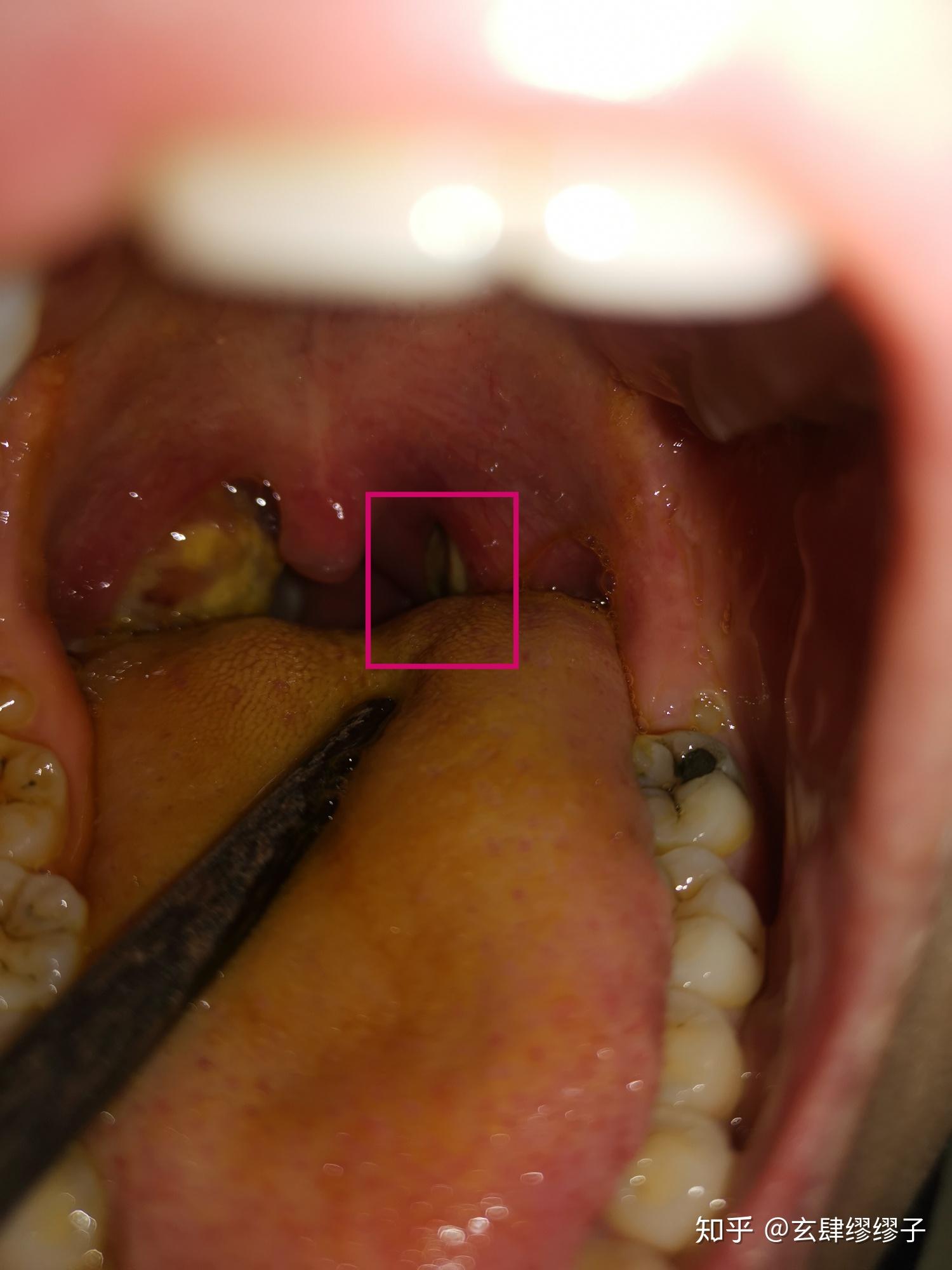 急性化脓性扁桃体炎的疼痛级别? - 知乎