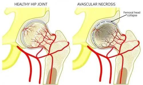 股骨头缺血性坏死