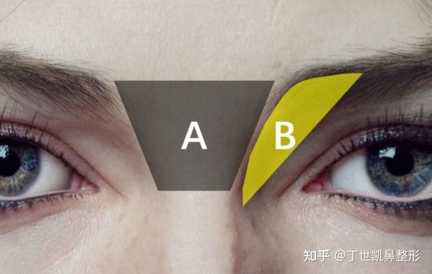 论鼻整形中眉心三角的重要性 - 知乎
