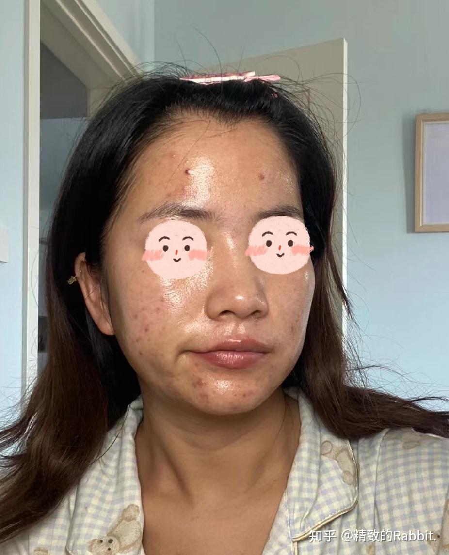 我就不信有谁能比我脸上的痘还多还更出油!