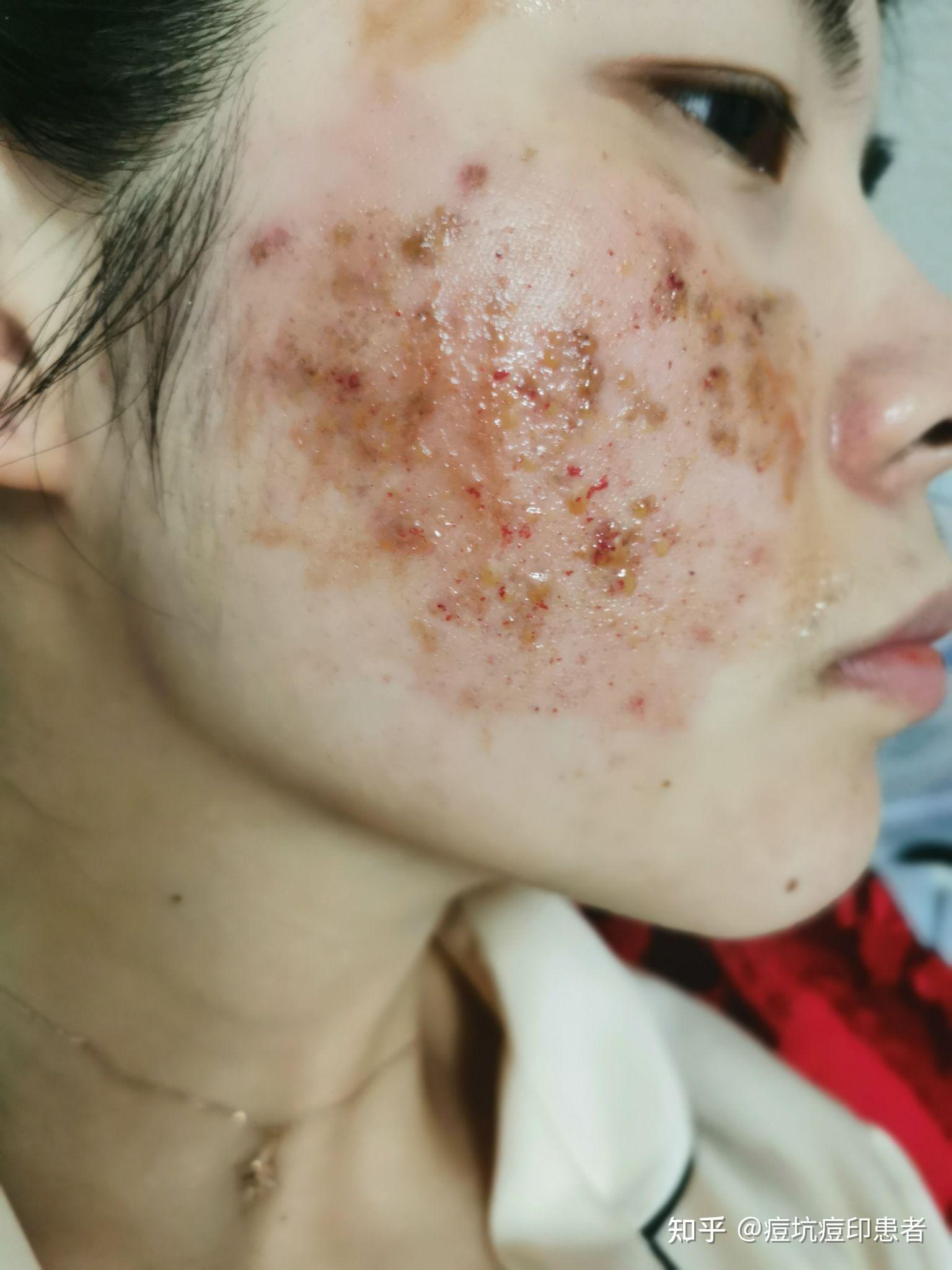 点阵激光恢复过程