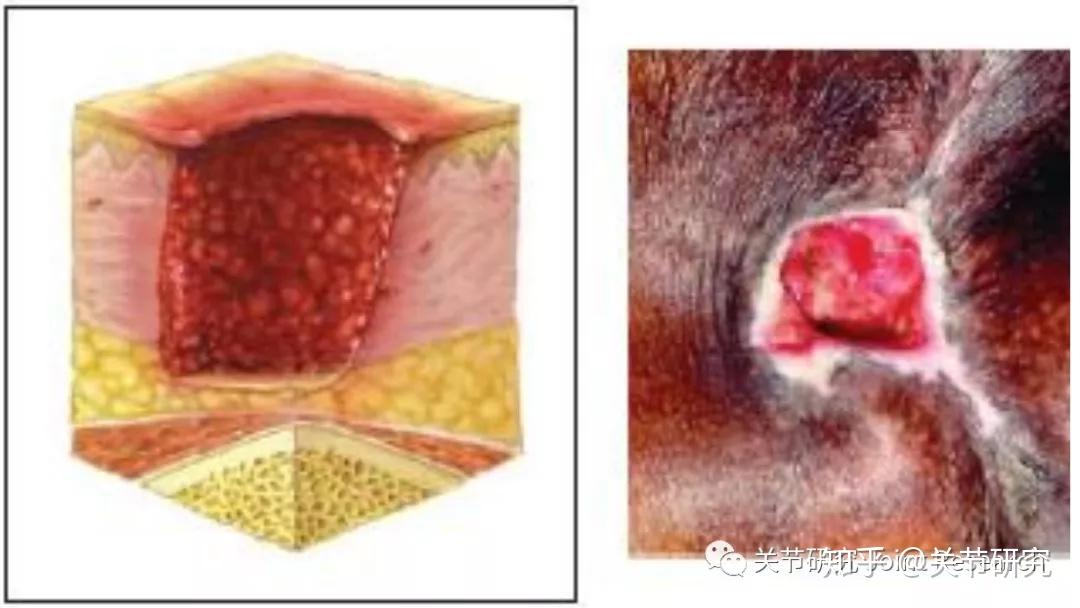 部分皮层缺失i 类/期:指压不变白的红斑认识分期很重要压疮的好发部位