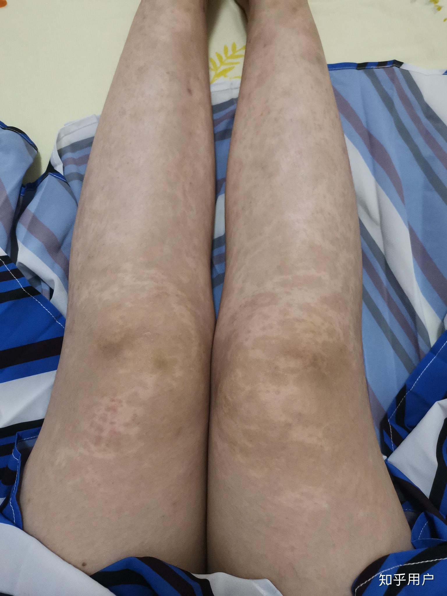 有人了解重症多形红斑吗应该怎么治愈