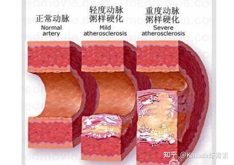 血管问题的形成原理 - 知乎