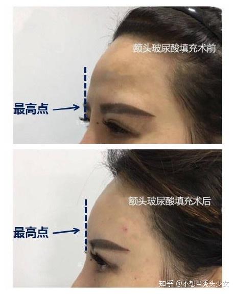 拥有一个饱满的额头有多重要,不会还有人不知道吧!