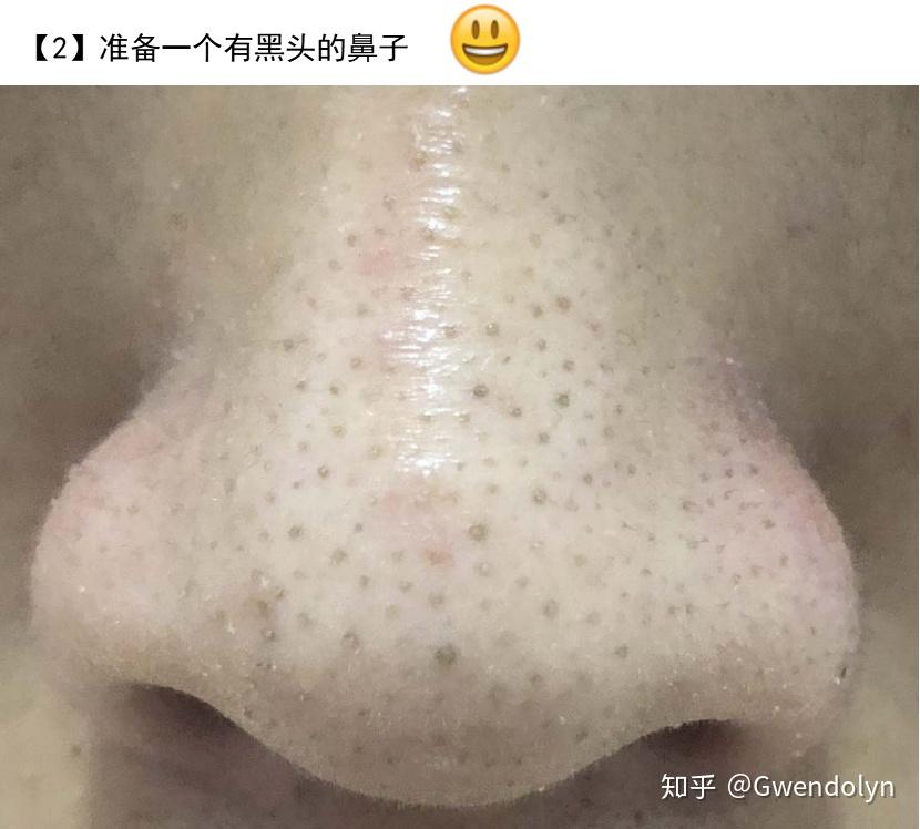 鼻子周围这是啥黑头吗还是毛孔大