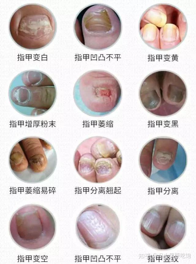 灰指甲的危害性有哪些图片