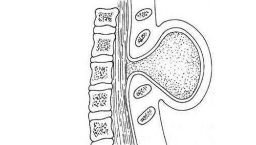 脊柱裂常见的症状有哪些