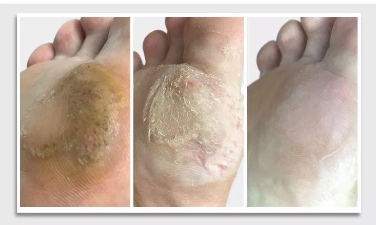 你不得不看的足疣20经典案例