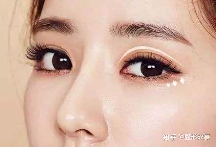 自己怎么拆线双眼皮 v2-773514427f8f95b5c7f31c905a4892b4_r.jpg