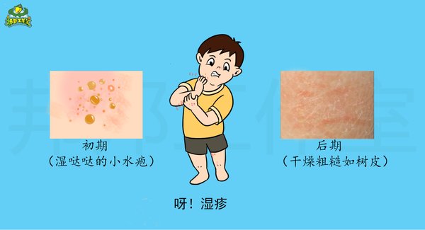 皮肤患了湿疹经常剧烈瘙痒 又干燥粗糙怎么办 知乎