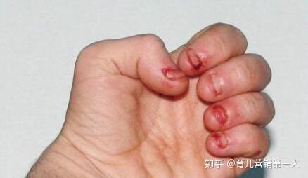 孩子总咬指甲,并非是缺维生素了,真正的原因在这里
