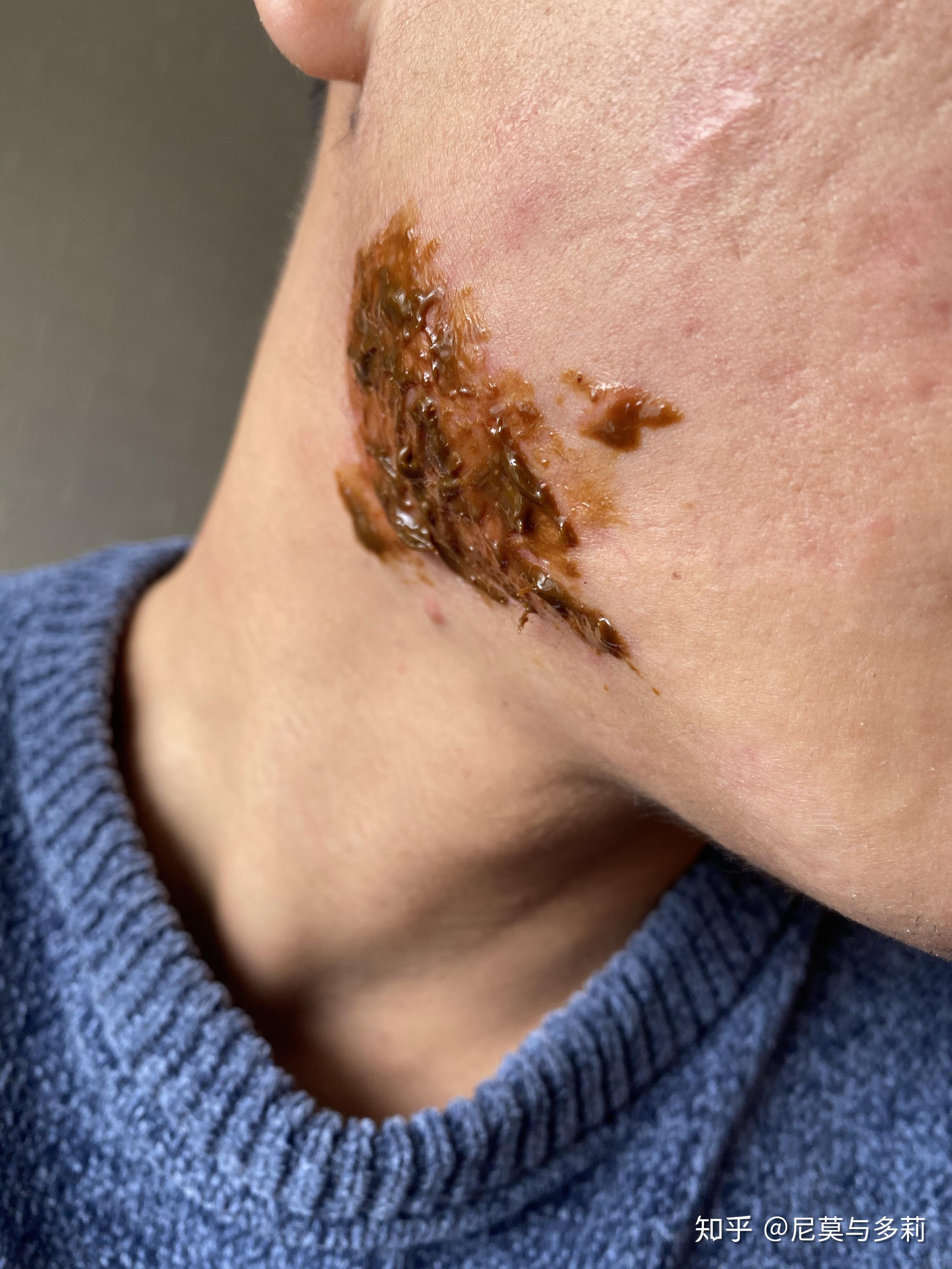 困扰我两年的腮部疤痕疙瘩,现在正在得以正确的治疗 (盗图必究!