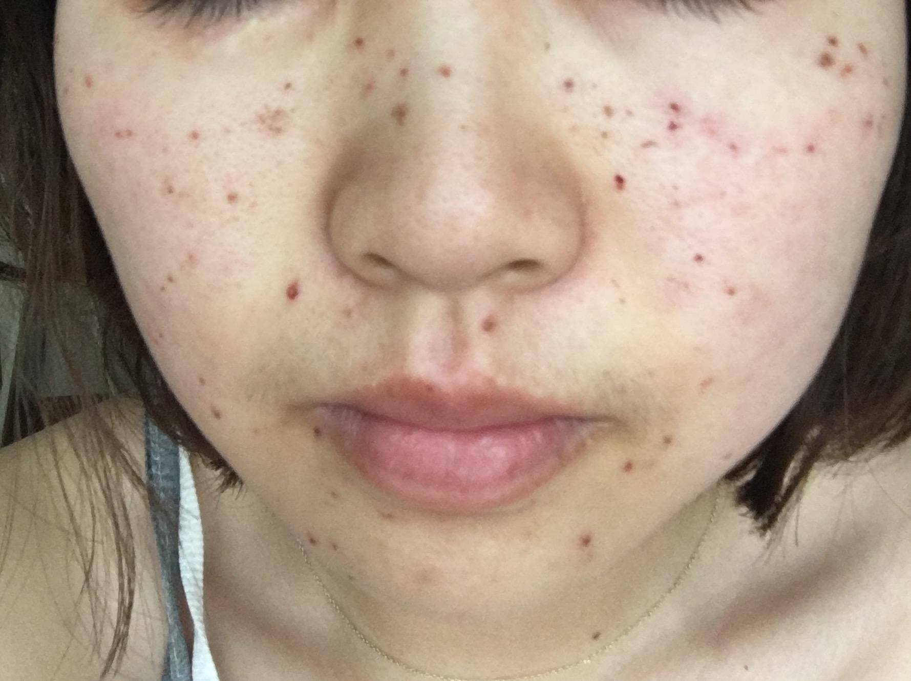 皮秒激光祛斑祛痣记录