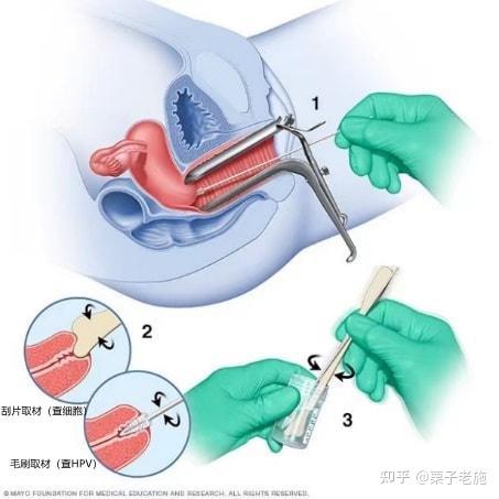 方法就是宫颈细胞学检查(tct或lct)联合人乳头瘤病毒(hpv)检查,可以