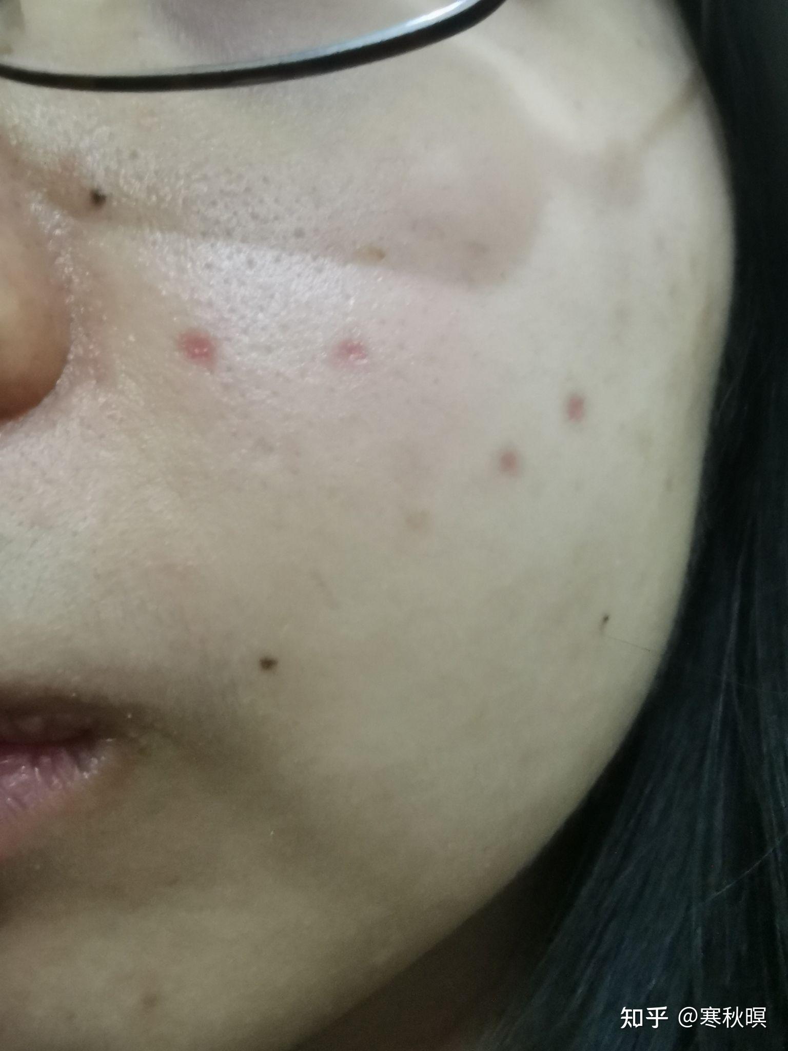 关于点痣的那些事，本人把所有的坑都踩了一遍…… - 知乎