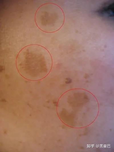 如何去除脸上的黑斑和斑点?(可能是全网最充分的建议了)