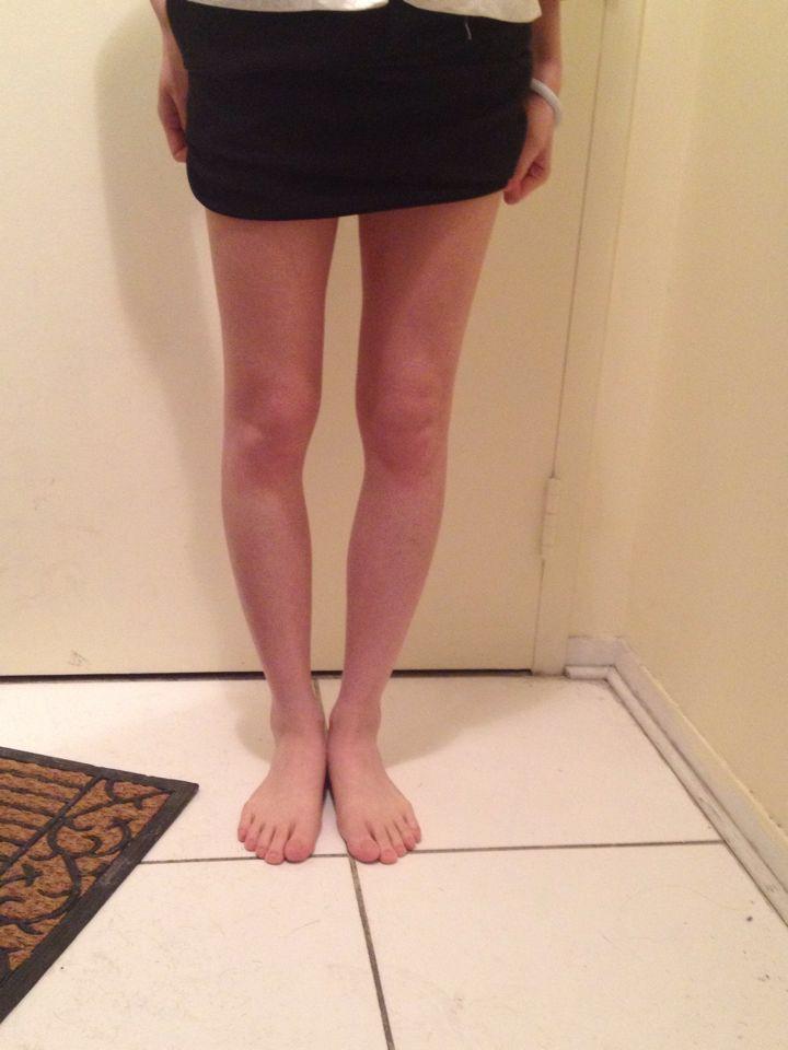 o型腿的人为什么跑不快而且感觉很费劲