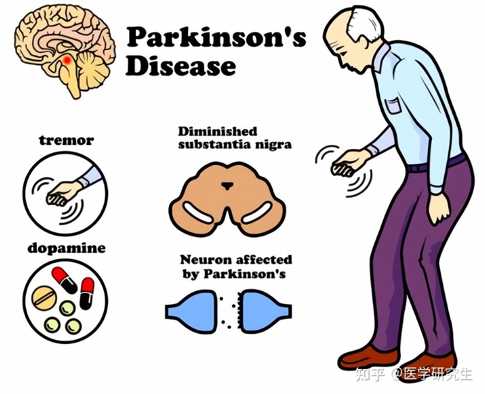 帕金森病是什么病都有哪些症状表现
