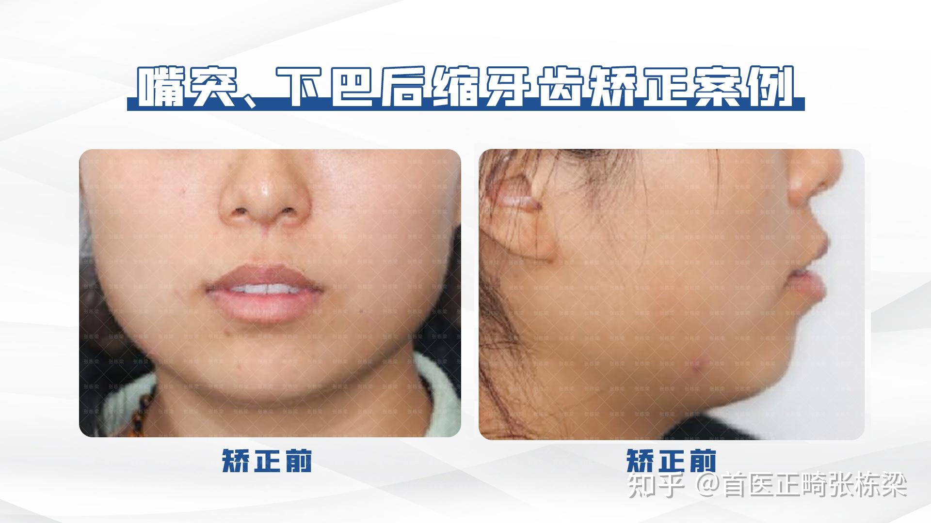 北京正畸 | 嘴突、开唇露齿颜值“受挫”怎么办?牙齿正畸来改善! - 知乎