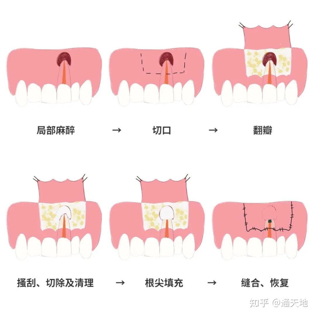 根尖手術-上顎第一大臼齒顎側牙根 | 高雄根管治療專家-牙髓病專科王俊欽牙醫師
