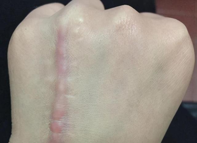 缝针后留下了凹陷疤痕怎么办?能修复平整吗?