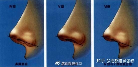 鼻小柱和鼻翼缘有什么关系?