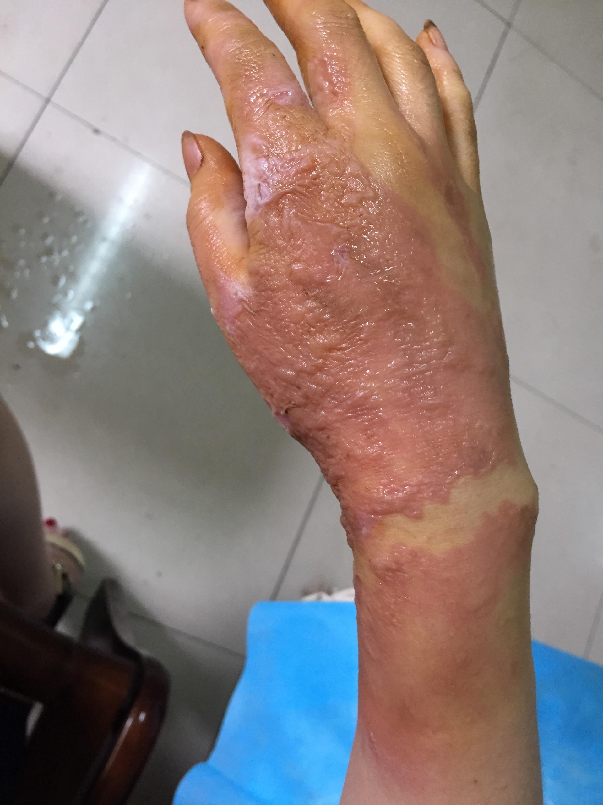 烫伤前后皮肤的具体变化是怎样的? - 知乎