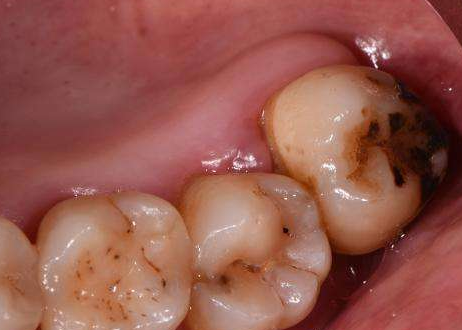 6人赞同了该文章 在人类进化的过程中,智齿是人类牙齿的残余