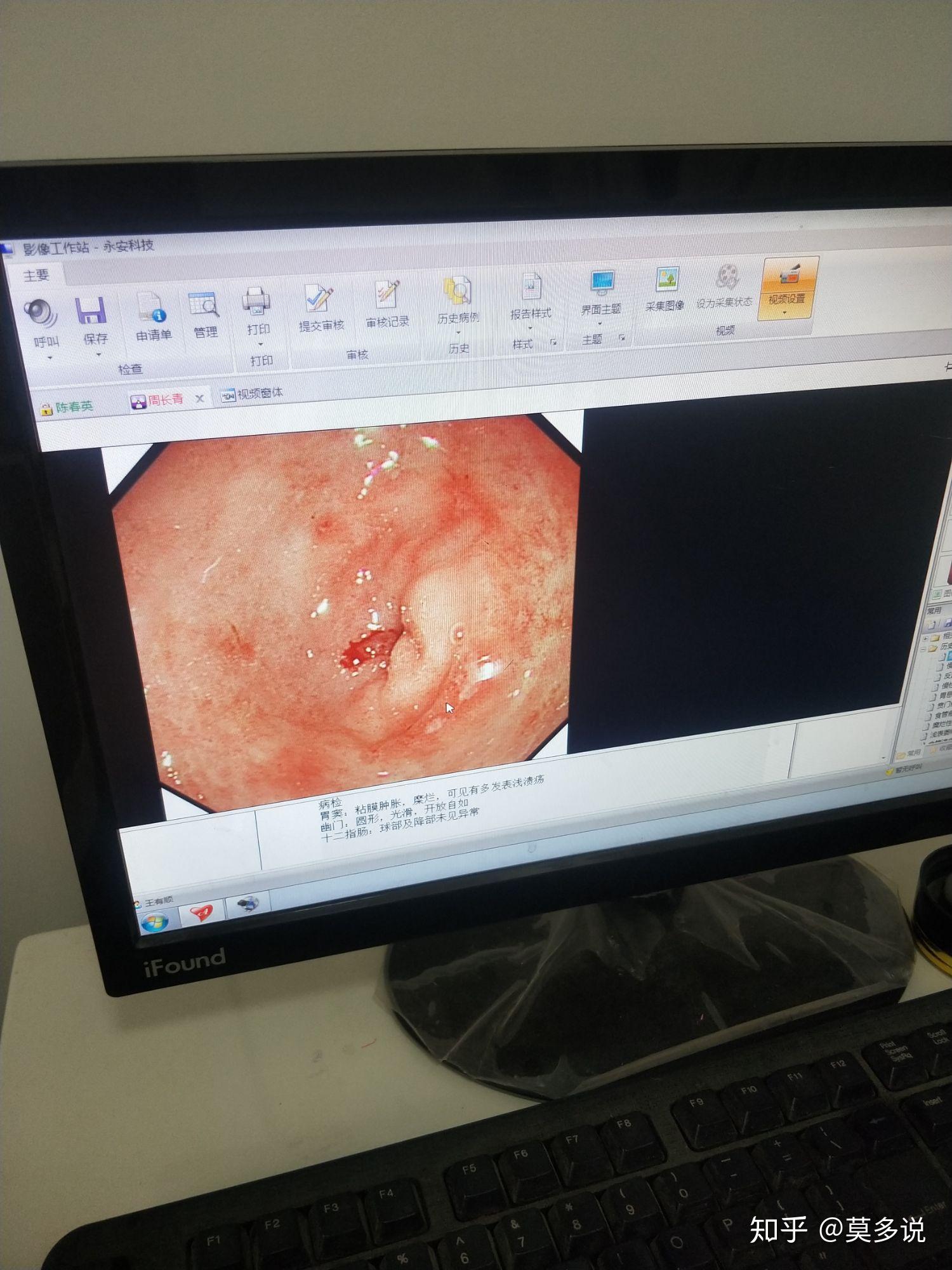 胃溃疡胃镜图严重图片