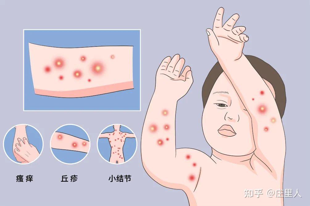 详细 讲解结节性痒疹怎么治疗 - 知乎
