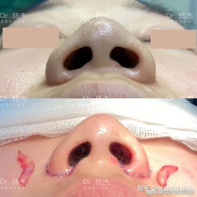 什么情况下缩鼻翼效果最好?