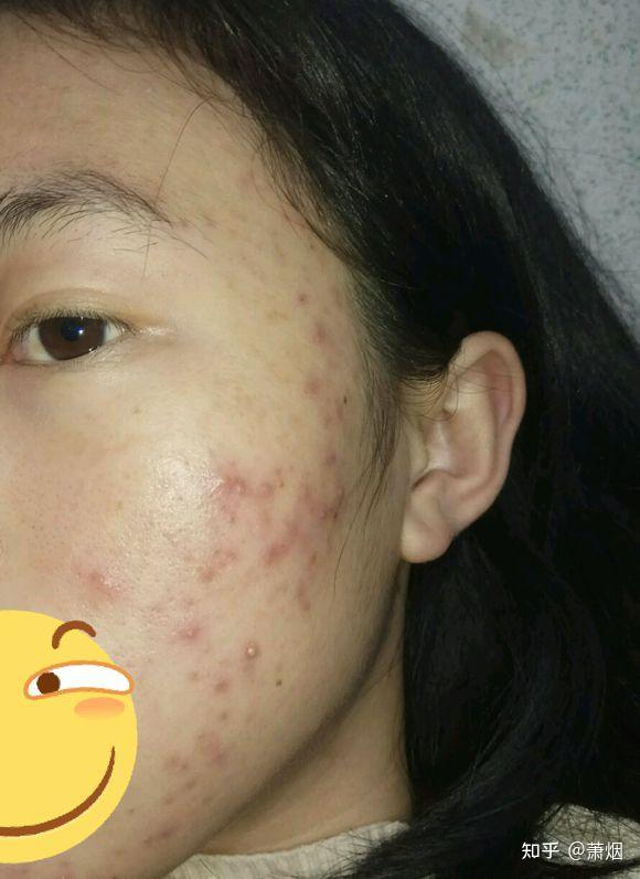 请问知乎的朋友们,我使用维a酸乳膏后过敏了,皮肤红肿,刺痛,特别干