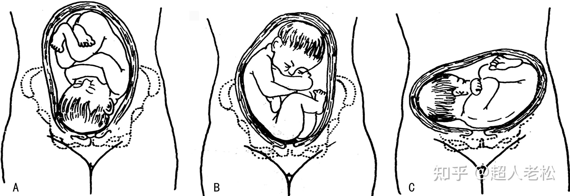 月安馨小课堂 逼真模拟胎儿臀位分娩
