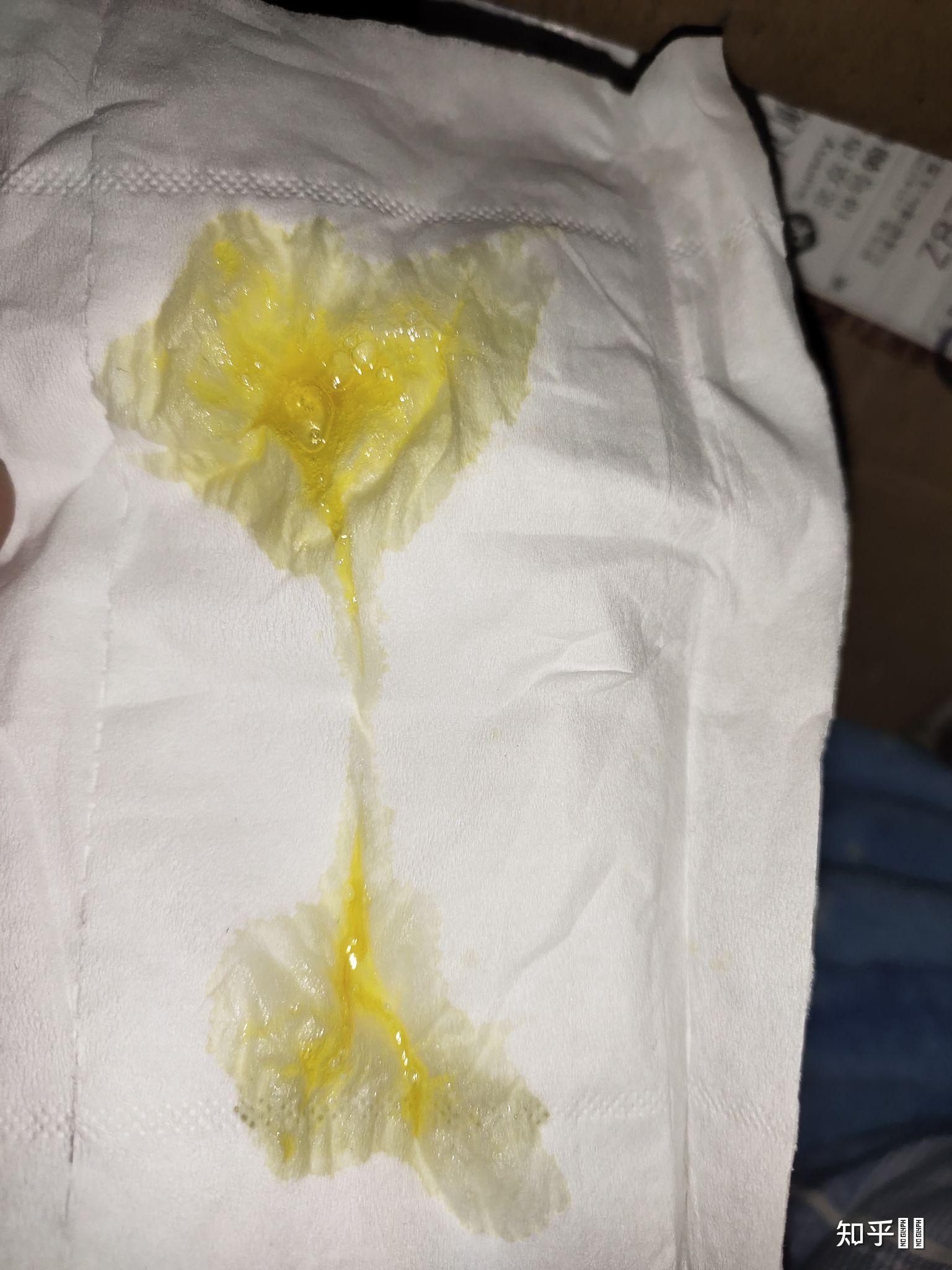 感冒了为什么现在的鼻涕是黄色的很艳很艳的亮黄色和颜料的颜色一样