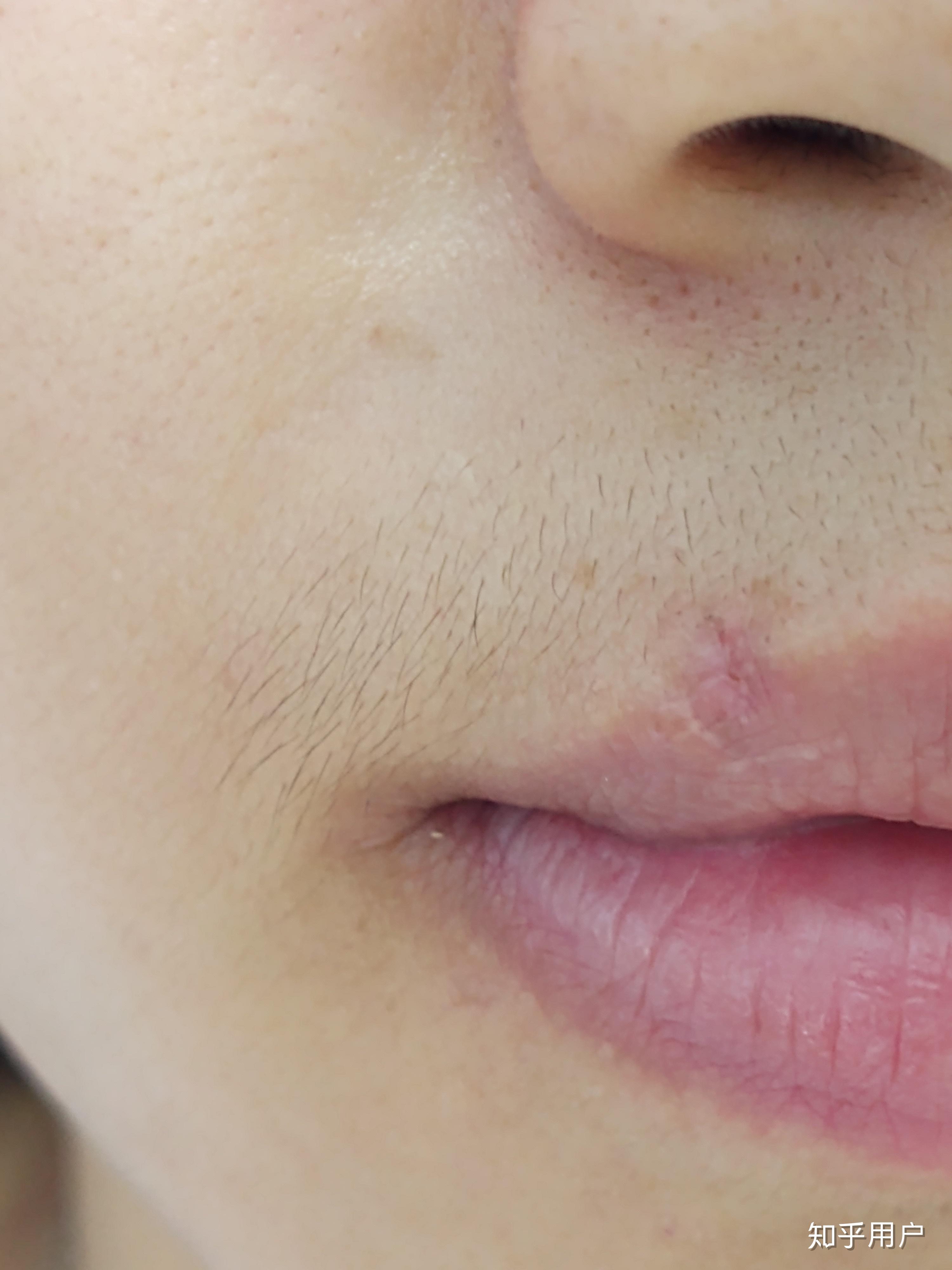 嘴唇上长痣怎么办 能不能点?