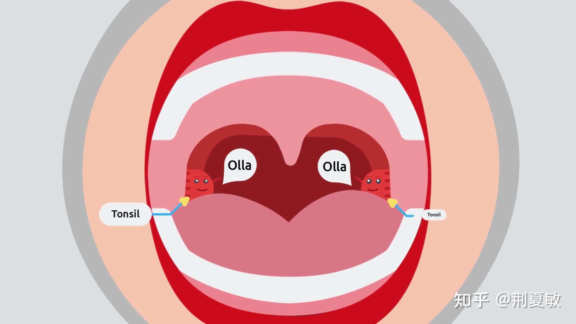 扁桃体角化症是否需要割掉扁桃体