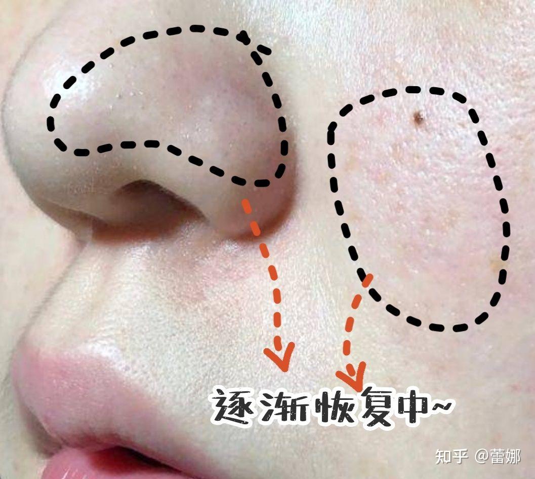 草莓鼻怎么办有什么好办法可以消除