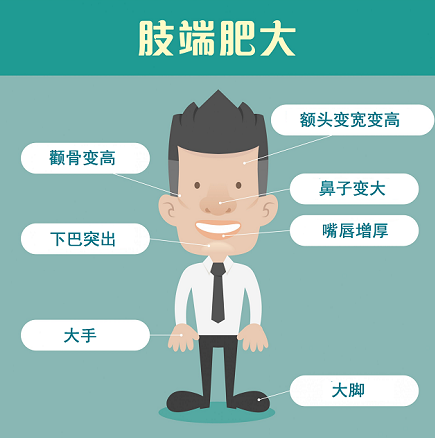 肢端肥大症最明显症状是手脚肿大治疗要配合全方位合理才行